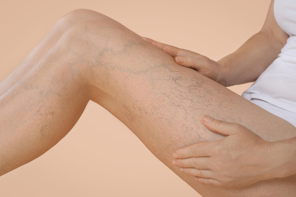 Quando a Pele Fala pelas Veias: Sinais Cutâneos Que Podem Indicar Doenças Vasculares Graves