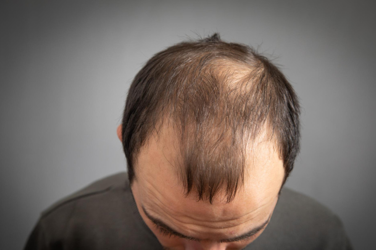 Alopecia androgenética: a condição capilar que afeta celebridades e pessoas comuns