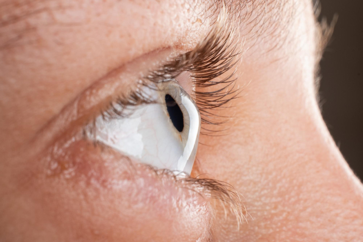 Ceratocone: Como Cuidar dos Olhos Desde os Primeiros Sinais
