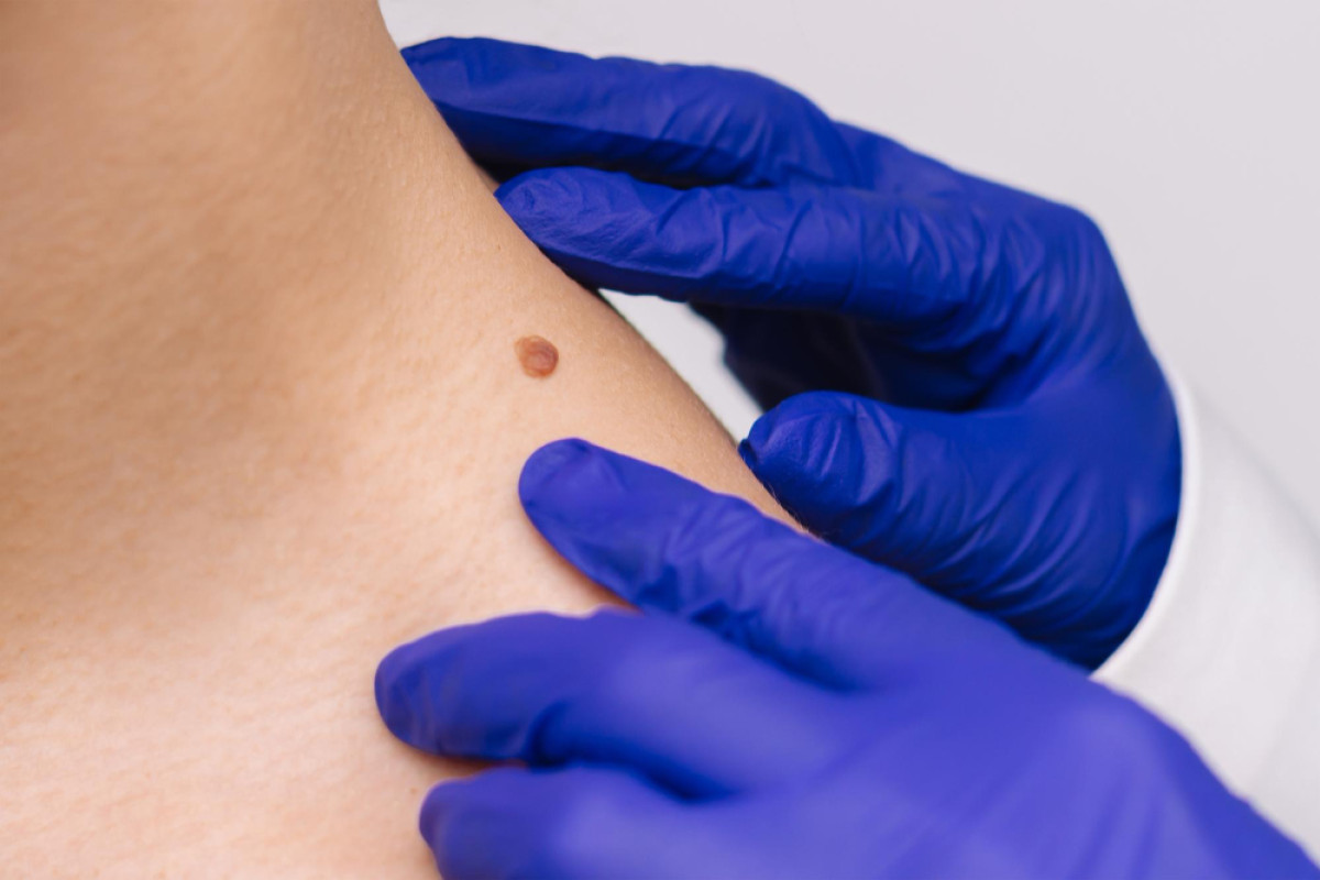 Cirurgia Sem Hospital: Como Cistos e Lipomas Podem Ser Removidos de Forma Simples e Segura