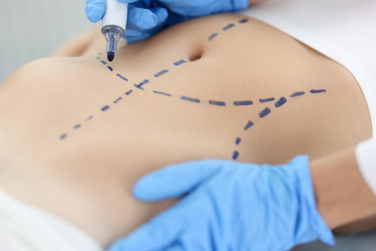 Cirurgia Plástica: Escolhas Erradas que Comprometem a Naturalidade dos Resultados