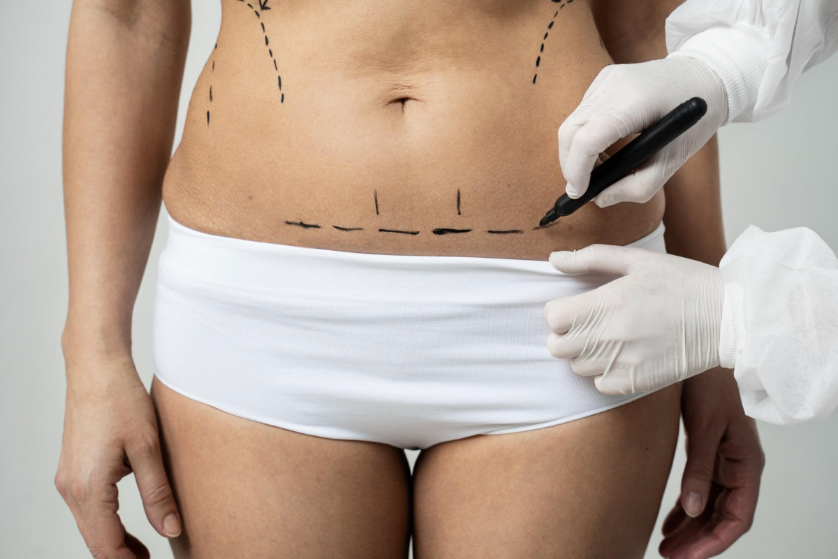 Lipoaspiração remodela áreas específicas e não é tratamento para emagrecer