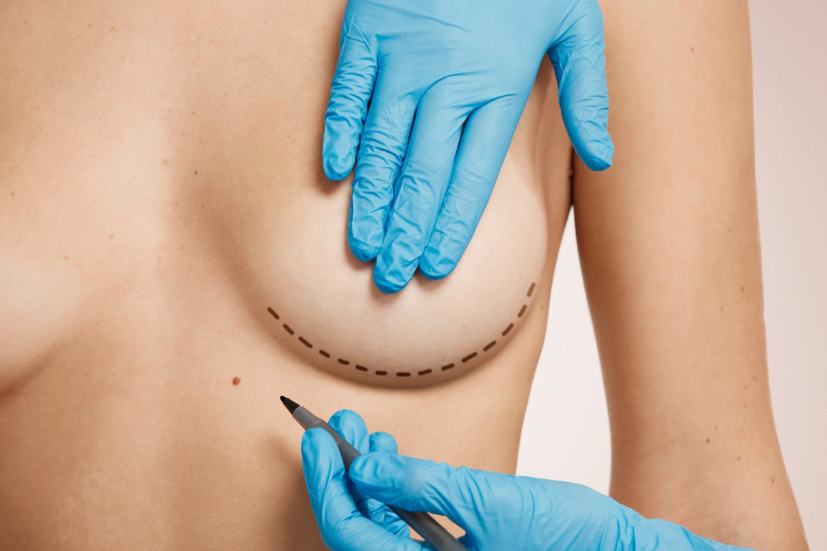Cicatriz em L: A Cirurgia Que Levanta e Remodela os Seios com Elegância