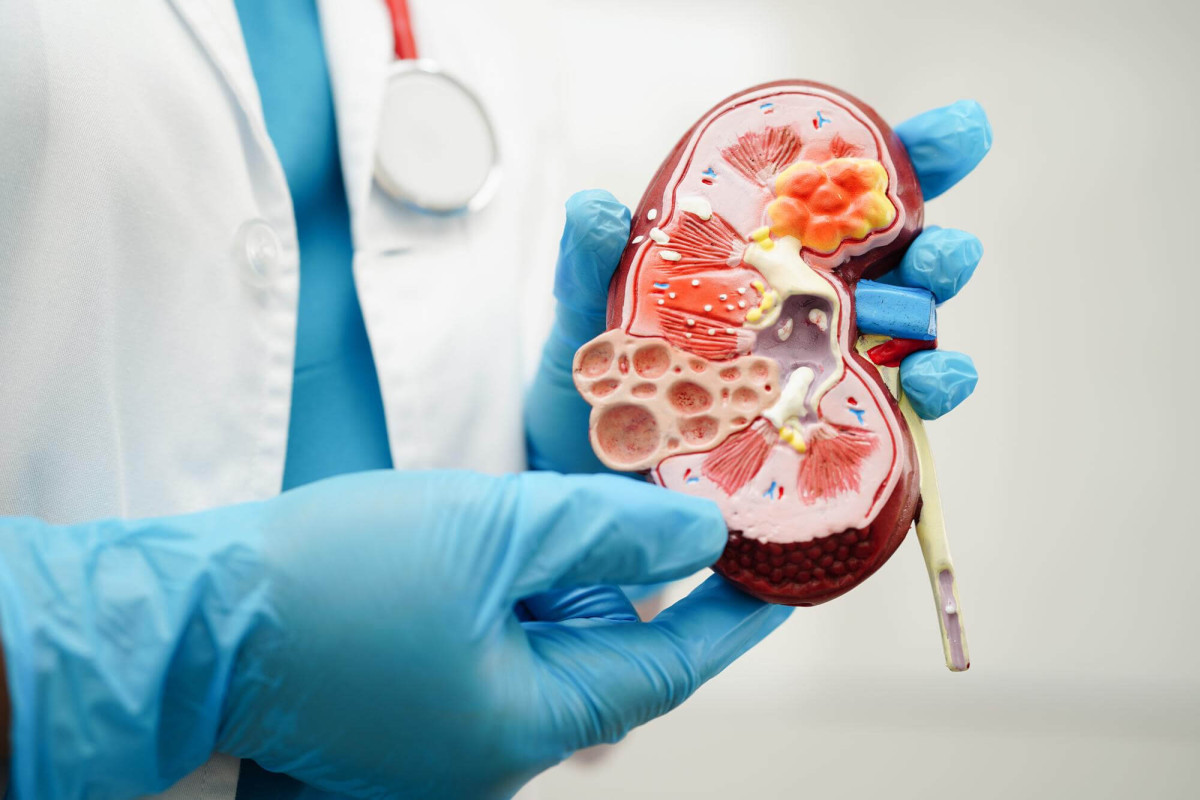 Transplante Renal Avanços que Transformam a Vida de Pacientes com Doença Renal Crônica
