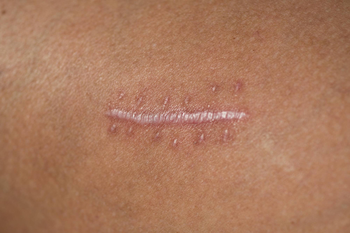 Cicatriz não é defeito: parte natural da recuperação após cirurgia plástica