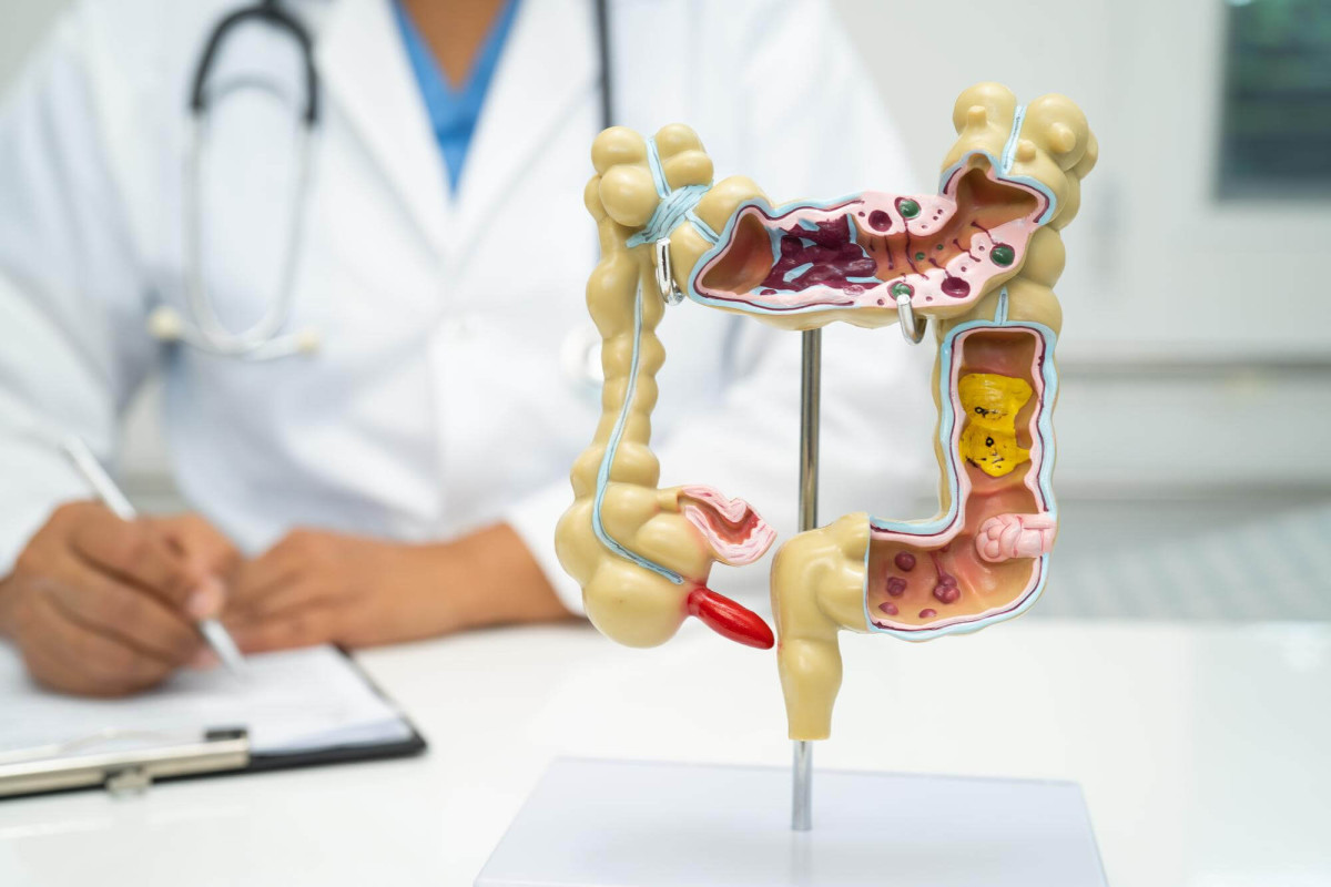 Câncer de intestino avança entre jovens e muda regras de rastreamento
