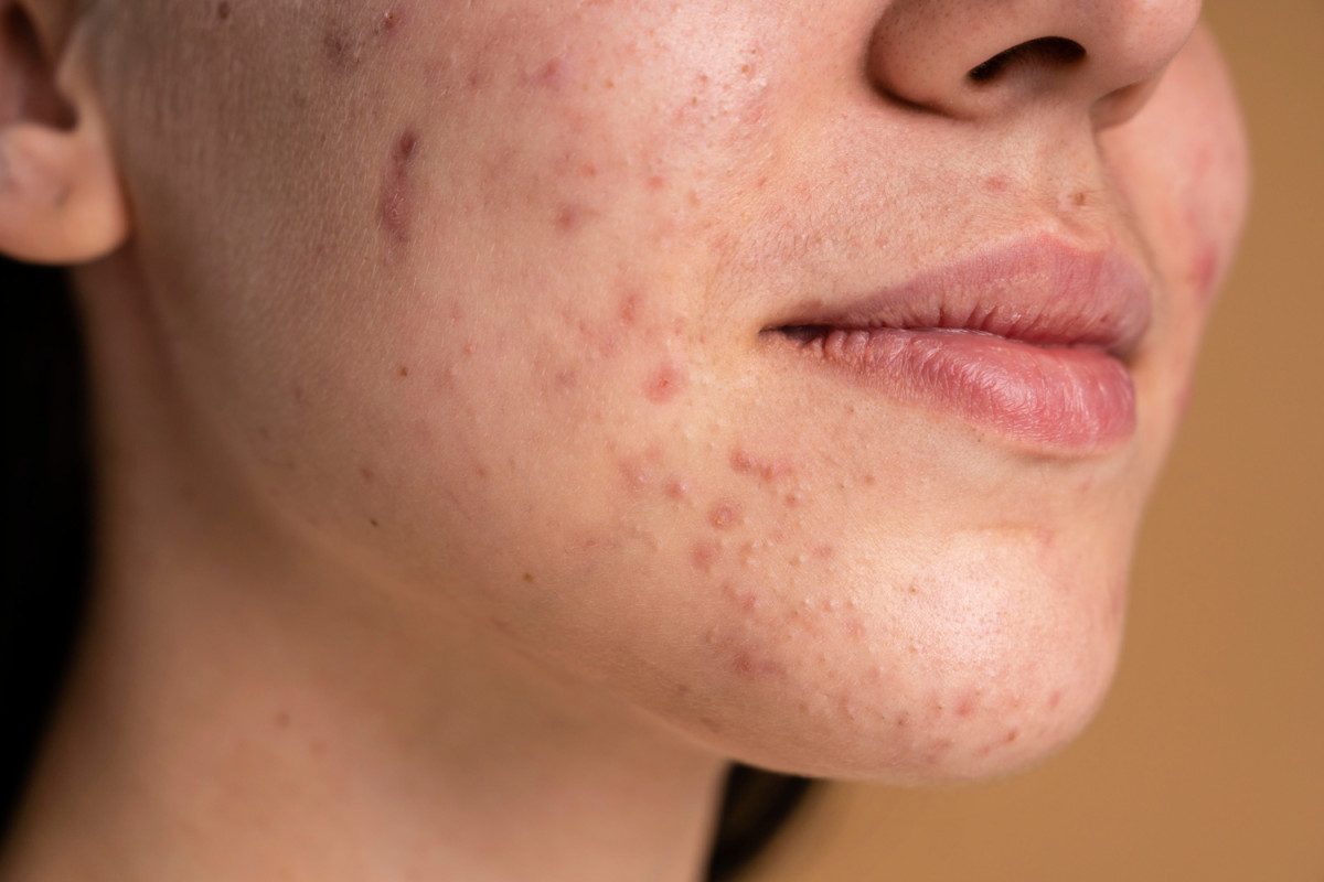 Sua pele está tentando avisar algo? Veja o que acne e manchas podem revelar