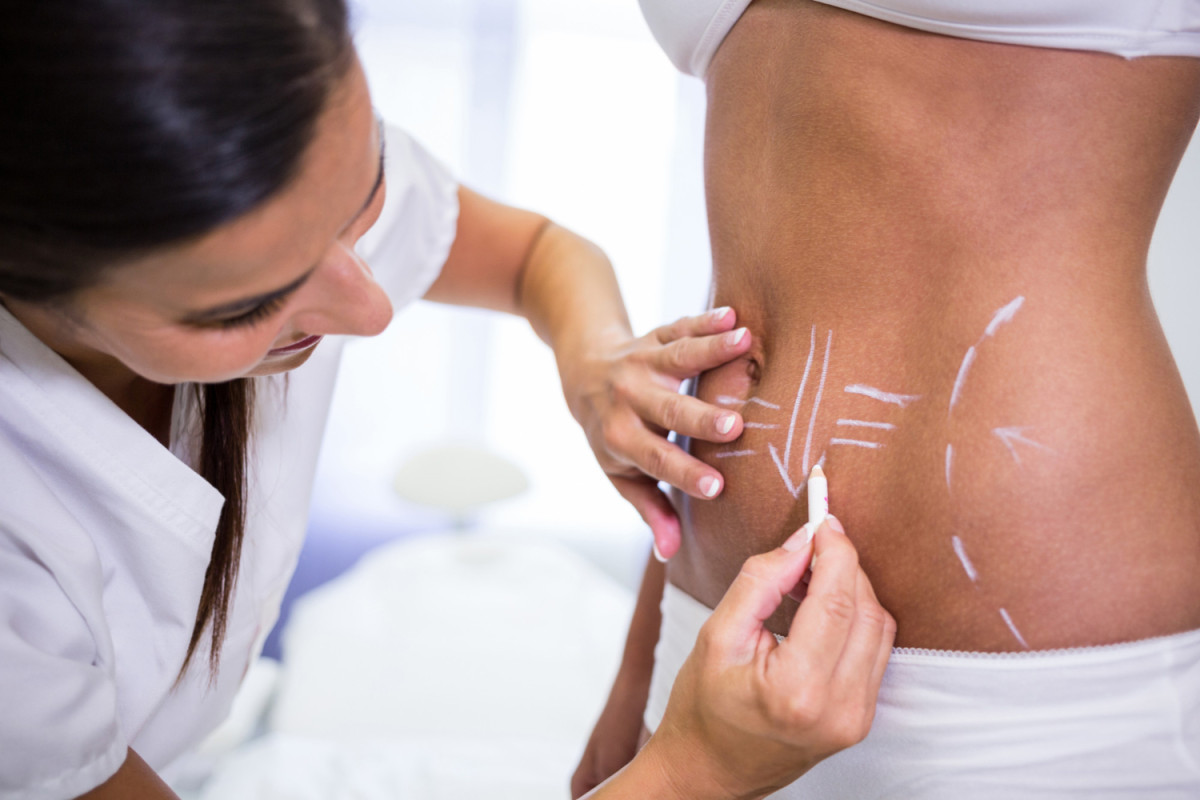 Abdominoplastia e lipo com retração: por que o resultado muda tanto de pessoa para pessoa