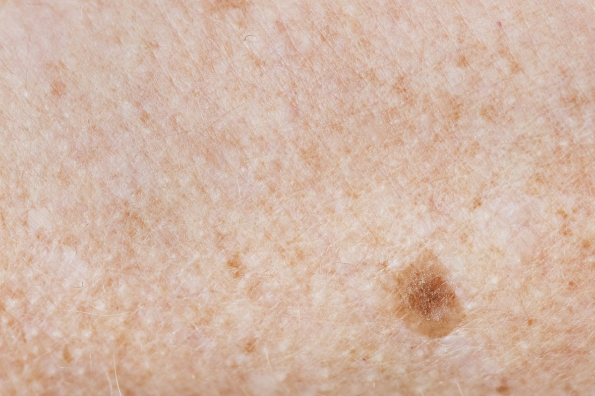 Carcinoma Espinocelular - O mais grave?