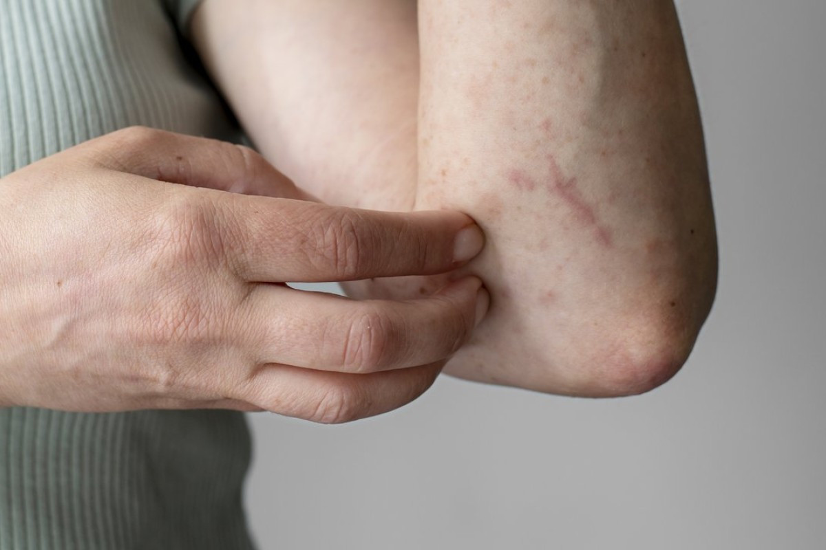 Dermatofibrossarcoma Protuberante
