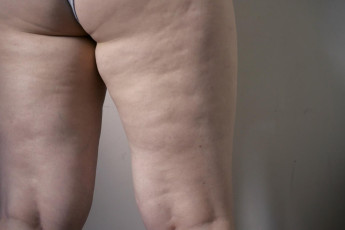 lipedema_dor_nas_pernas_e_roxos_frequentes_podem_indicar_a_doenca.jpg