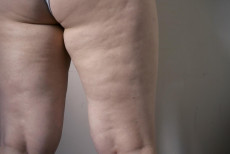 lipedema_dor_nas_pernas_e_roxos_frequentes_podem_indicar_a_doenca.jpg