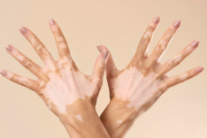 dia_mundial_do_vitiligo_alerta_para_mitos_e_impacto_emocional_das_manchas_na_pele.jpg
