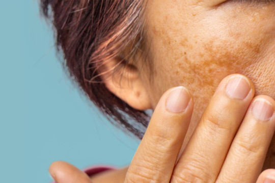 melasma_no_inverno_o_segredo_da_estacao_para_clarear_manchas_sem_ilusao.jpg