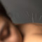 acupuntura_pode_ajudar_a_aliviar_sintomas_de_rinite_e_outras_alergias_no_inverno.jpg