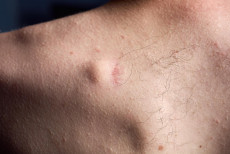 caroco_sob_a_pele_quando_um_lipoma_precisa_de_avaliacao_medica.jpg