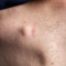 caroco_sob_a_pele_quando_um_lipoma_precisa_de_avaliacao_medica.jpg